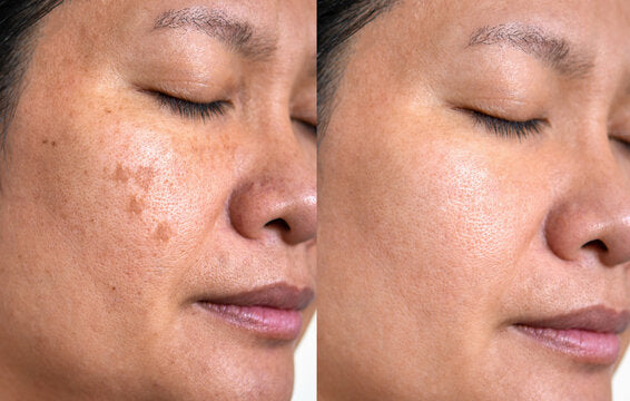 Nivoro™ - Korean toner pads